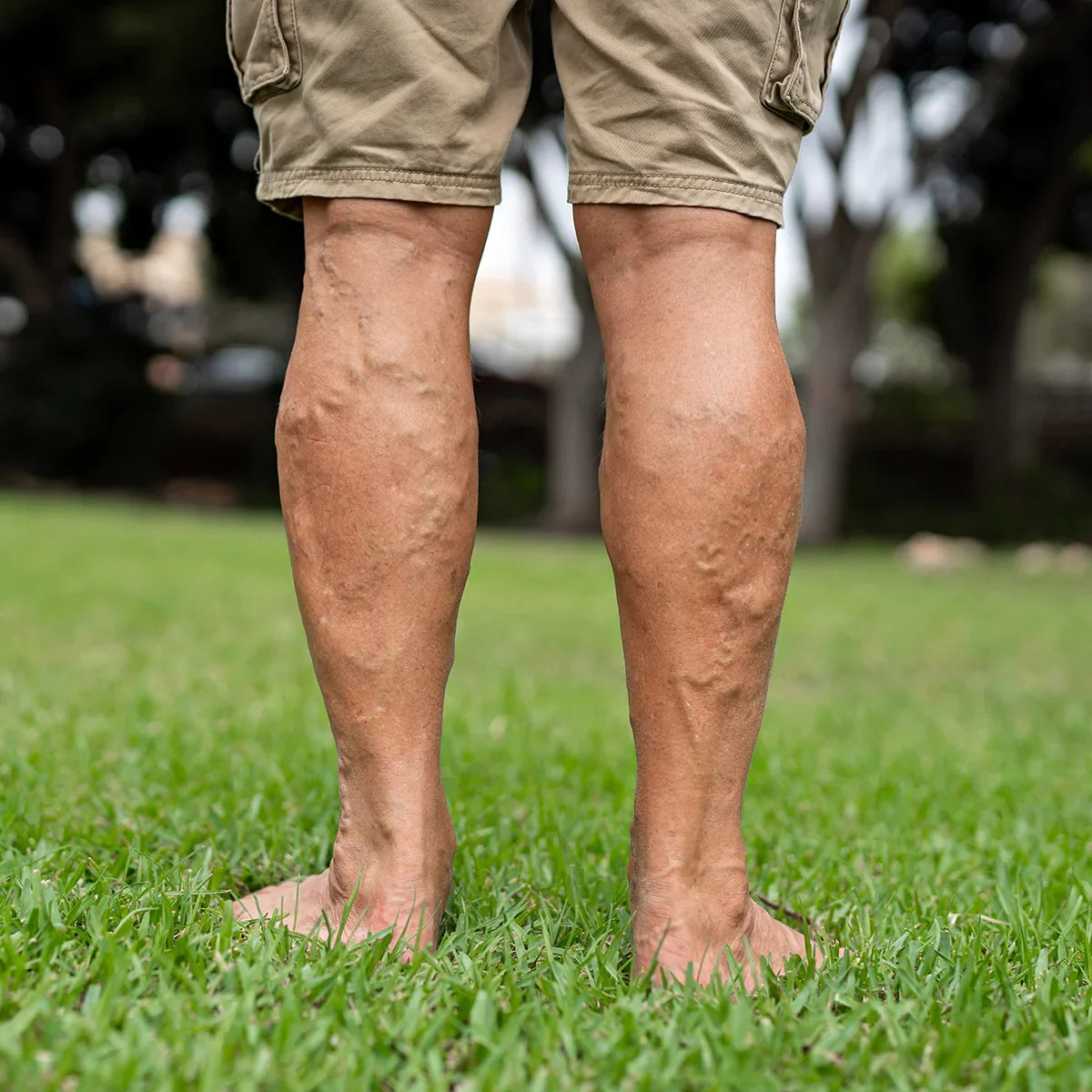 VARICOREX Varicose Vein relief Healing spray • 100ml - Mannavita